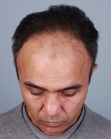 Before Hair Transplant&nbsp;Front